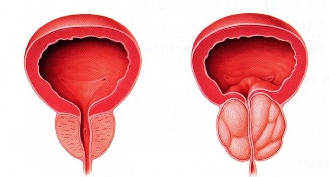 zdravá a zanícená prostata s chronickou prostatitidou