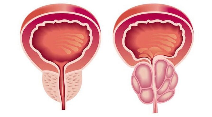 Zdravá a zanícená prostata prostatitidou